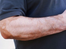 甲醛超標和白癜風有關系嗎？裝修污染對人體影響極大！